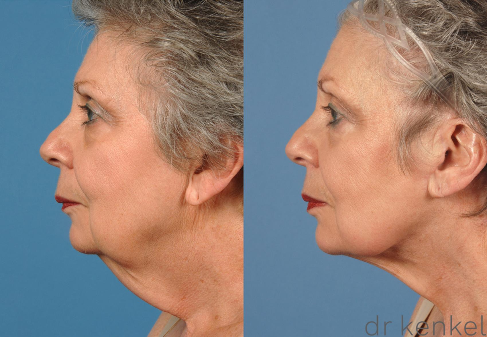 Before & After Neck Lift Case 147 View #2 View in Dallas, TX