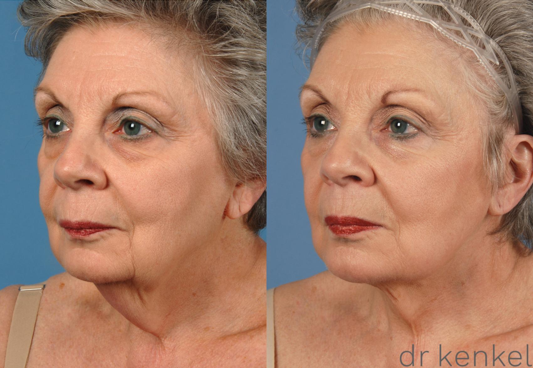 Before & After Neck Lift Case 147 View #3 View in Dallas, TX