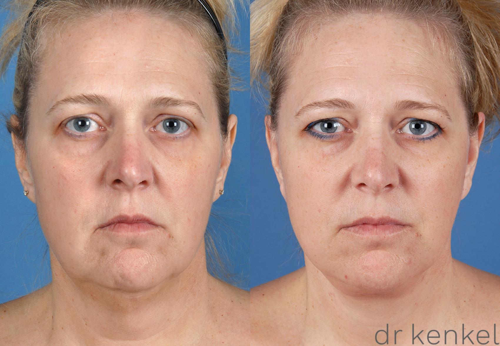 Before & After Neck Lift Case 163 View #1 View in Dallas, TX