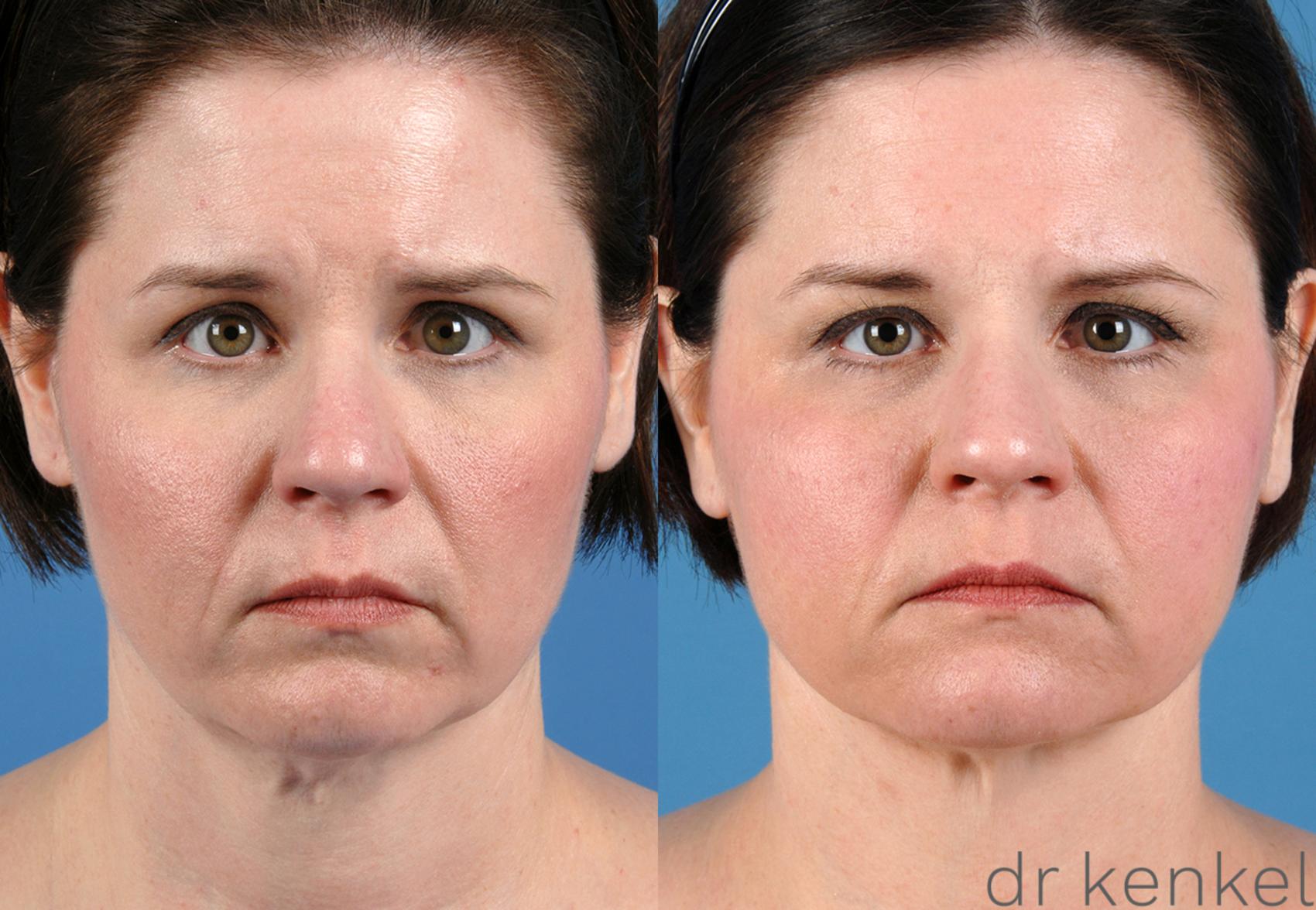 Before & After Neck Lift Case 164 View #1 View in Dallas, TX