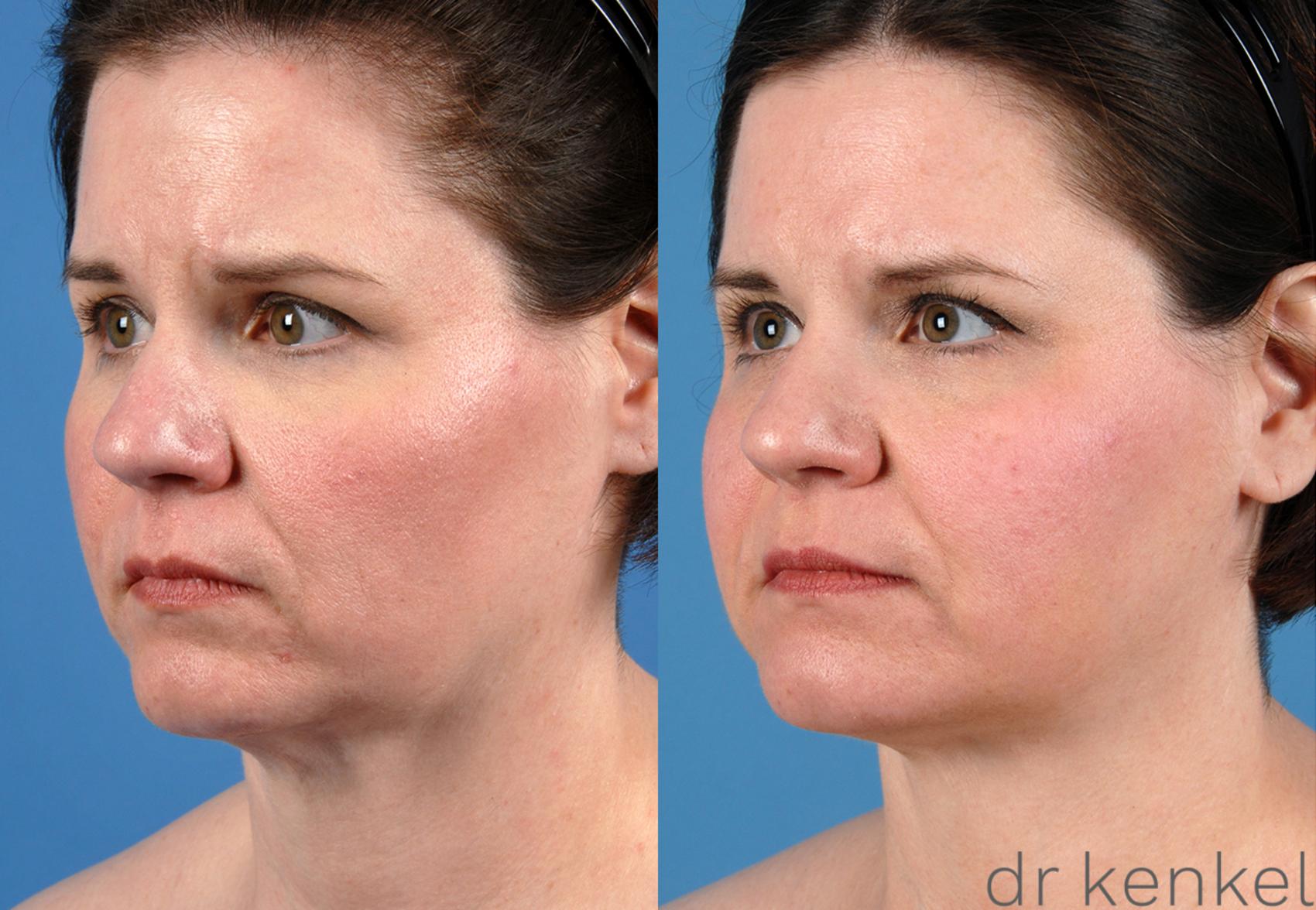 Before & After Neck Lift Case 164 View #2 View in Dallas, TX