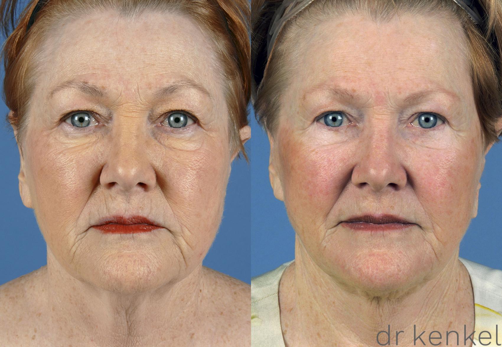 Before & After Neck Lift Case 167 View #1 View in Dallas, TX
