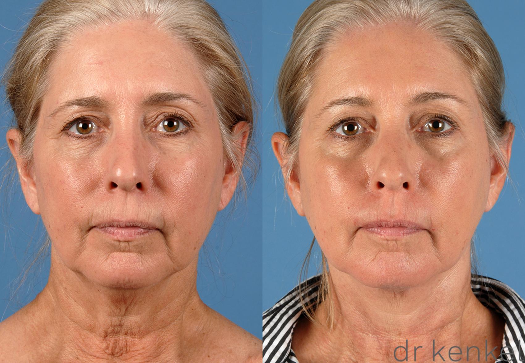 Before & After Neck Lift Case 252 View #1 View in Dallas, TX