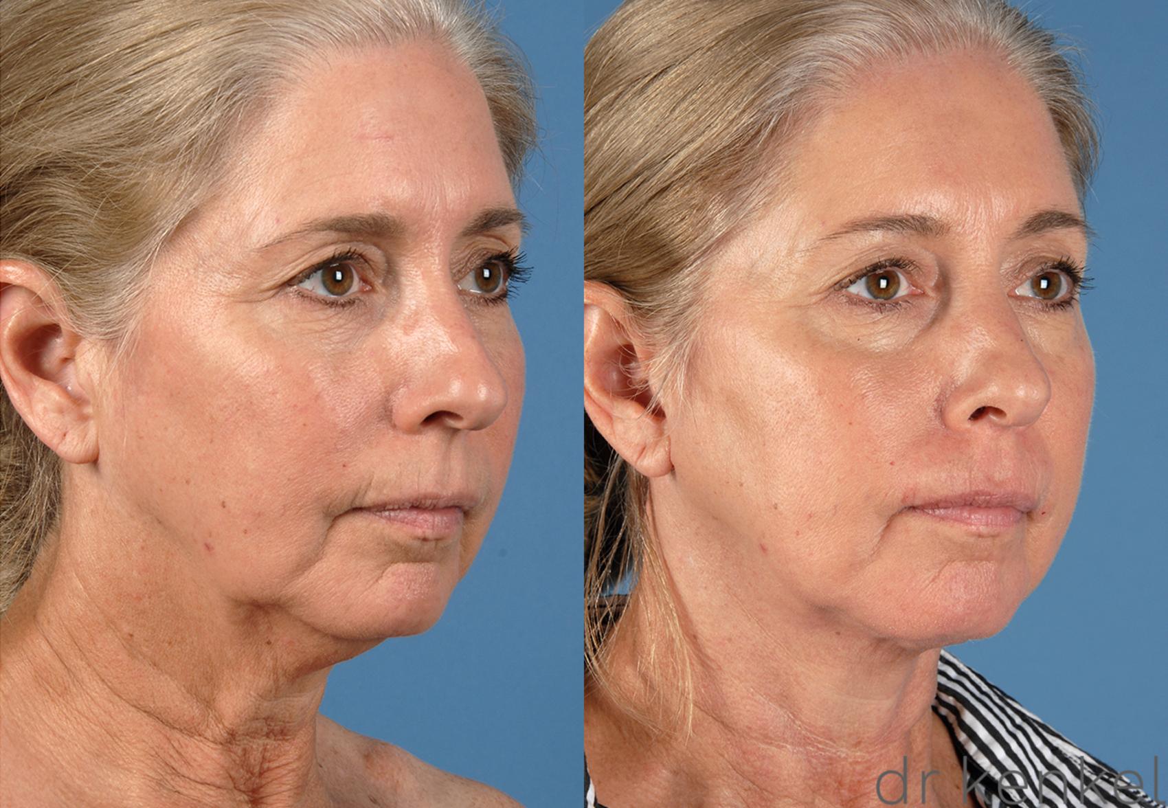 Before & After Neck Lift Case 252 View #2 View in Dallas, TX