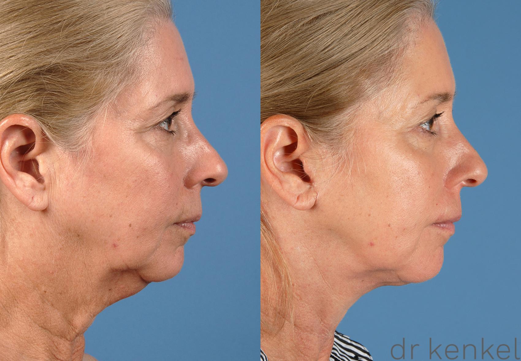 Before & After Neck Lift Case 252 View #3 View in Dallas, TX
