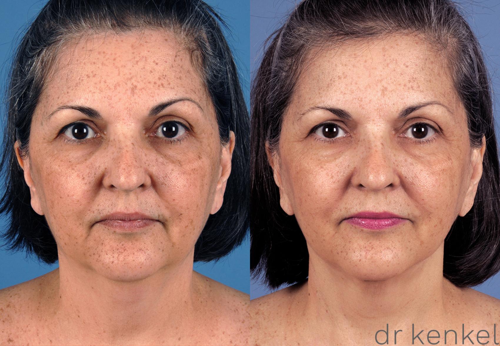Before & After Neck Lift Case 260 View #1 View in Dallas, TX