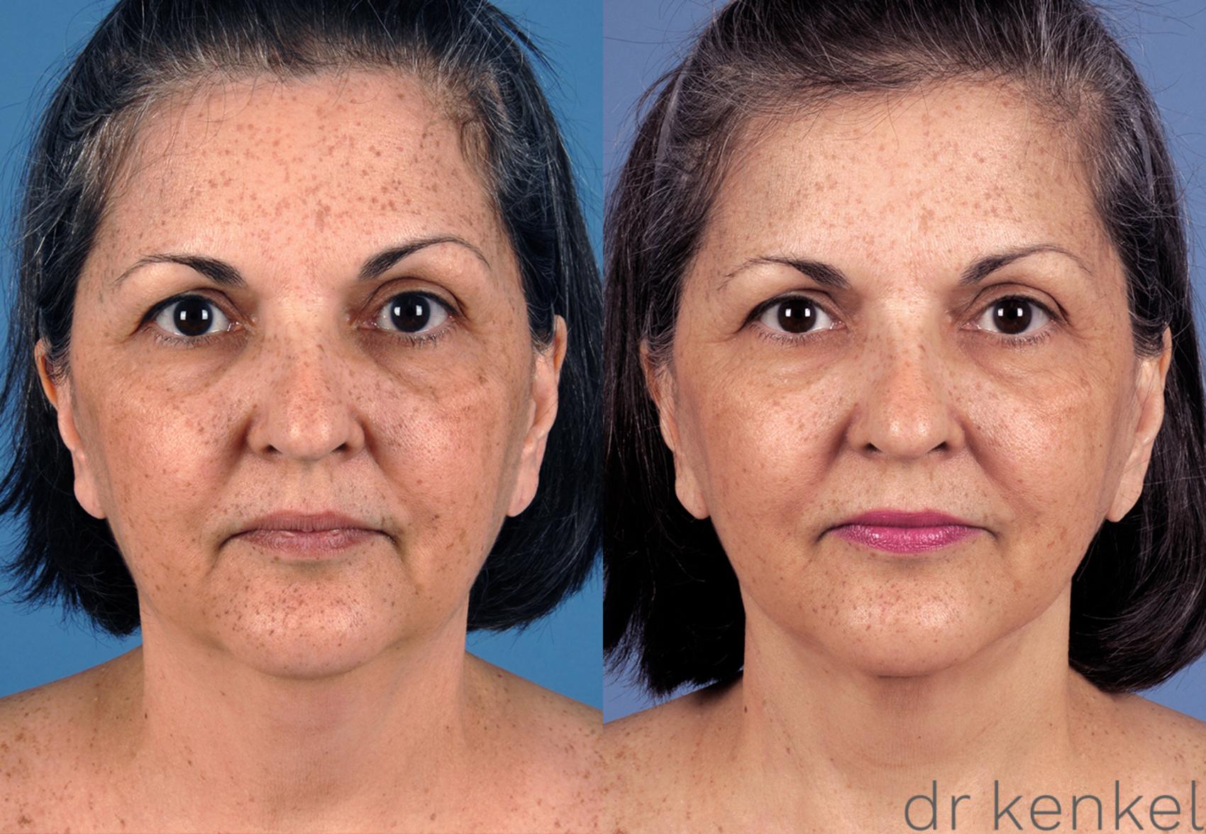 Before & After Neck Lift Case 260 View #1 View in Dallas, Frisco, McKinney, Prosper, Allen, Celina, Denton, Anna, TX