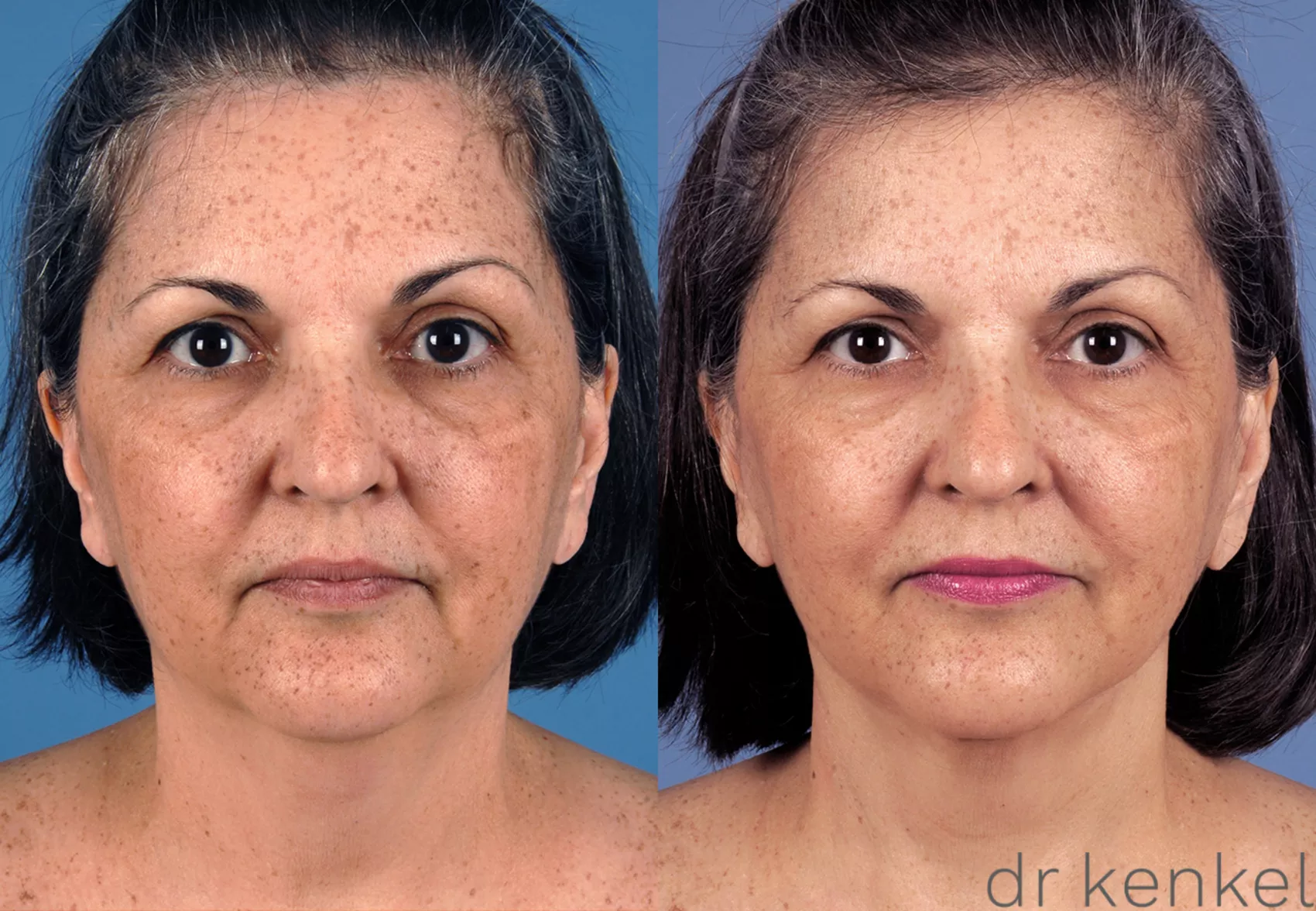 neck-lift-260-view-1-detail.webp