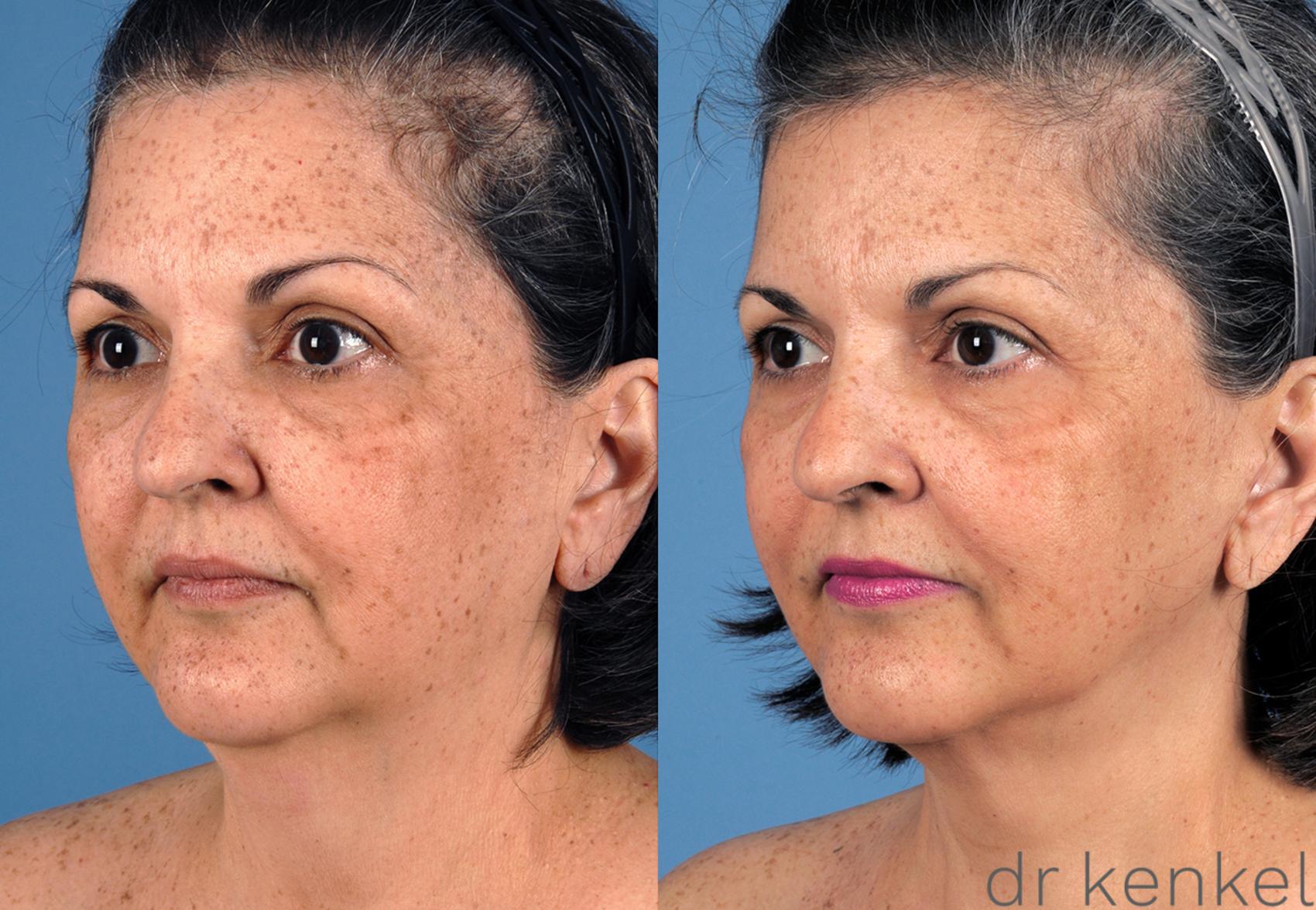 Before & After Neck Lift Case 260 View #2 View in Dallas, TX