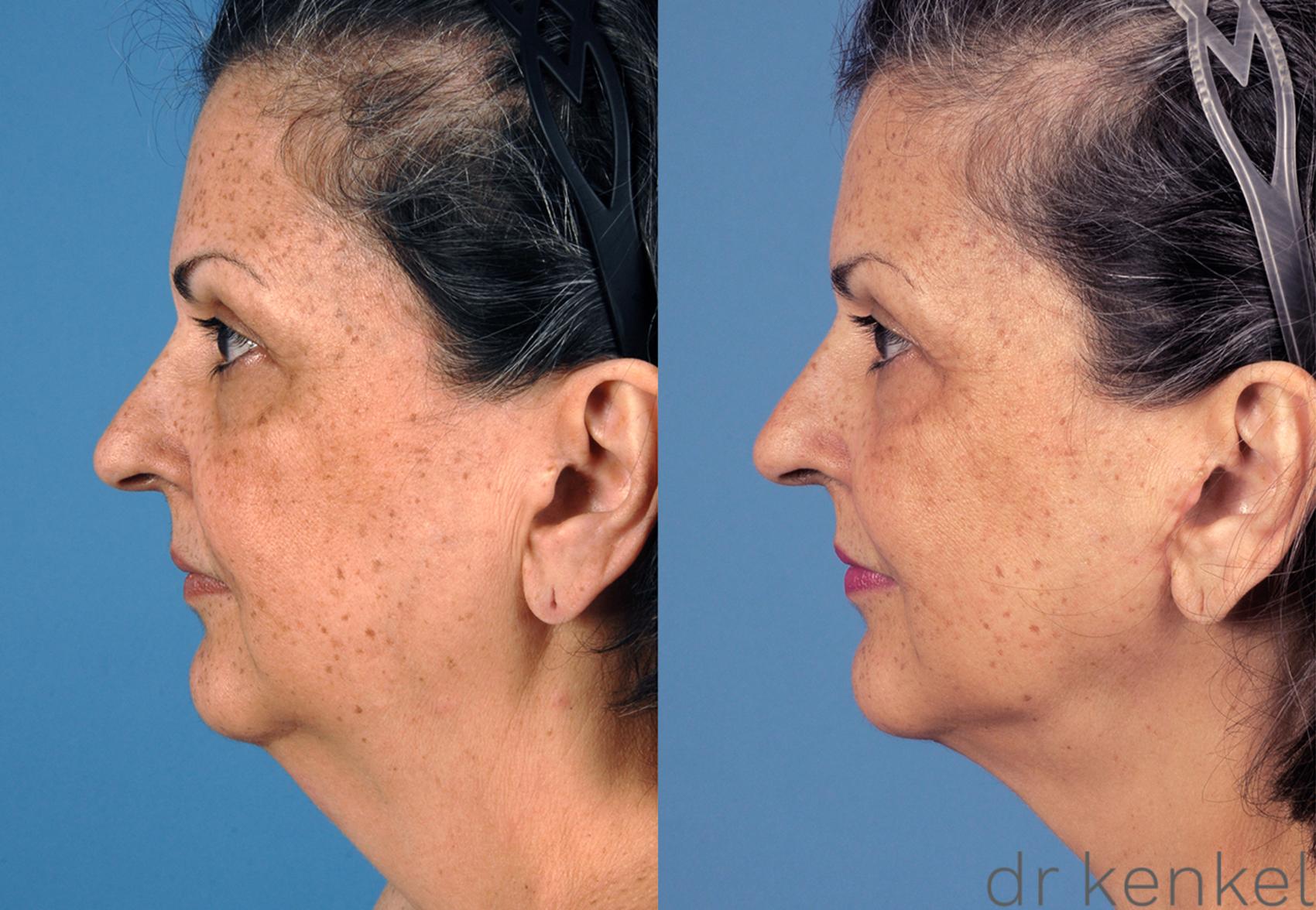 Before & After Neck Lift Case 260 View #3 View in Dallas, TX