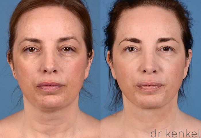 Before & After Injectables Case 277 View #1 View in Dallas, Frisco, McKinney, Prosper, Allen, Celina, Denton, Anna, TX