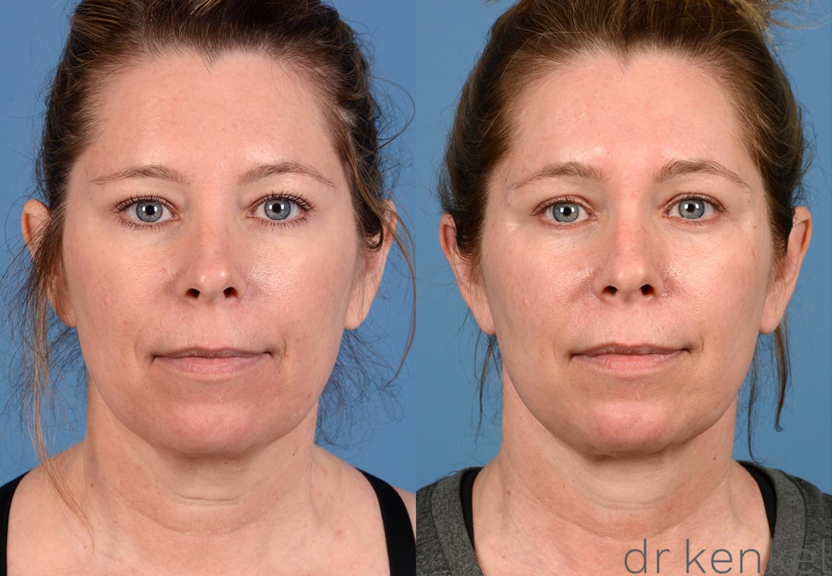 Before & After Neck Lift Case 281 View #1 View in Dallas, TX