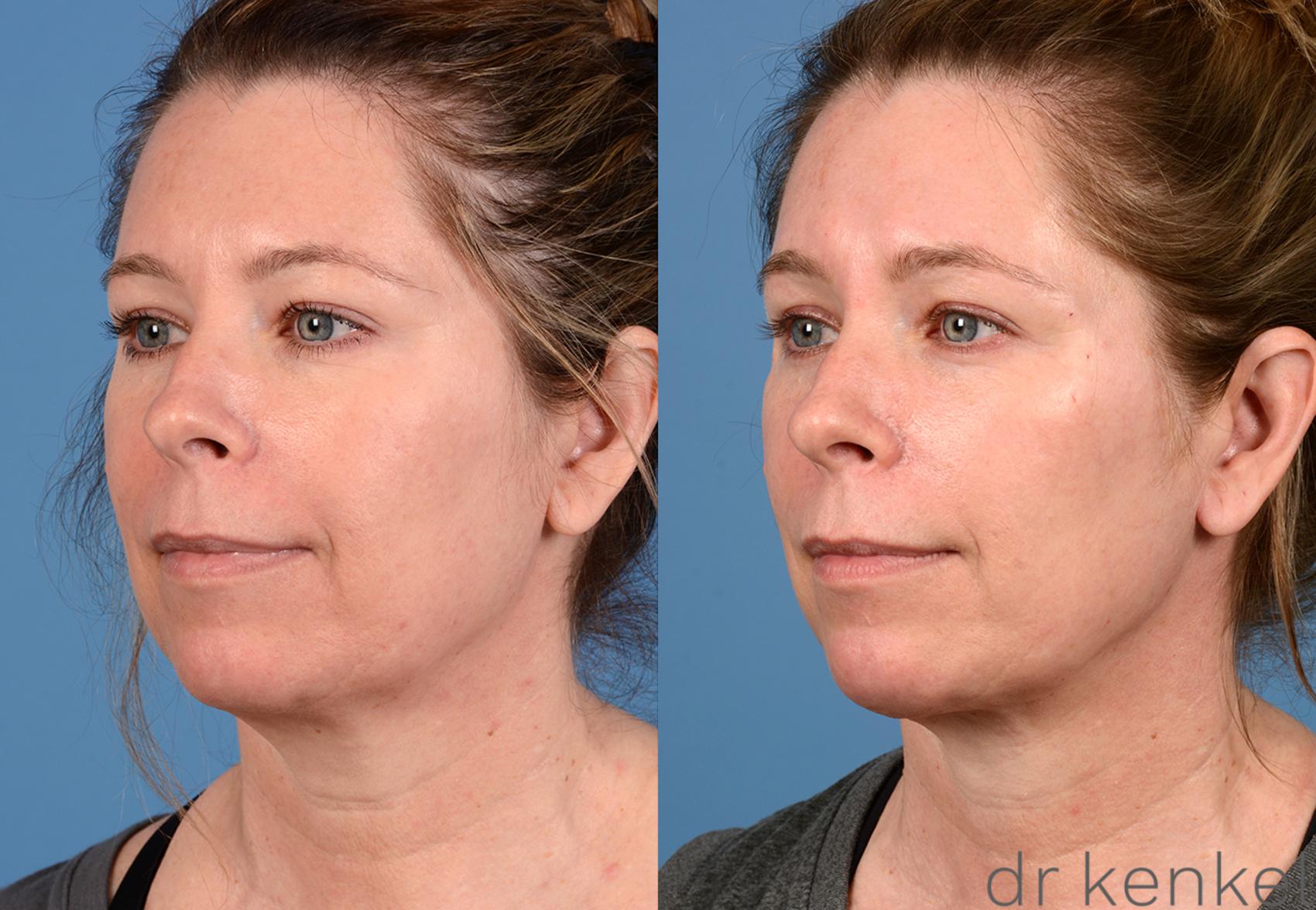 Before & After Neck Lift Case 281 View #2 View in Dallas, TX