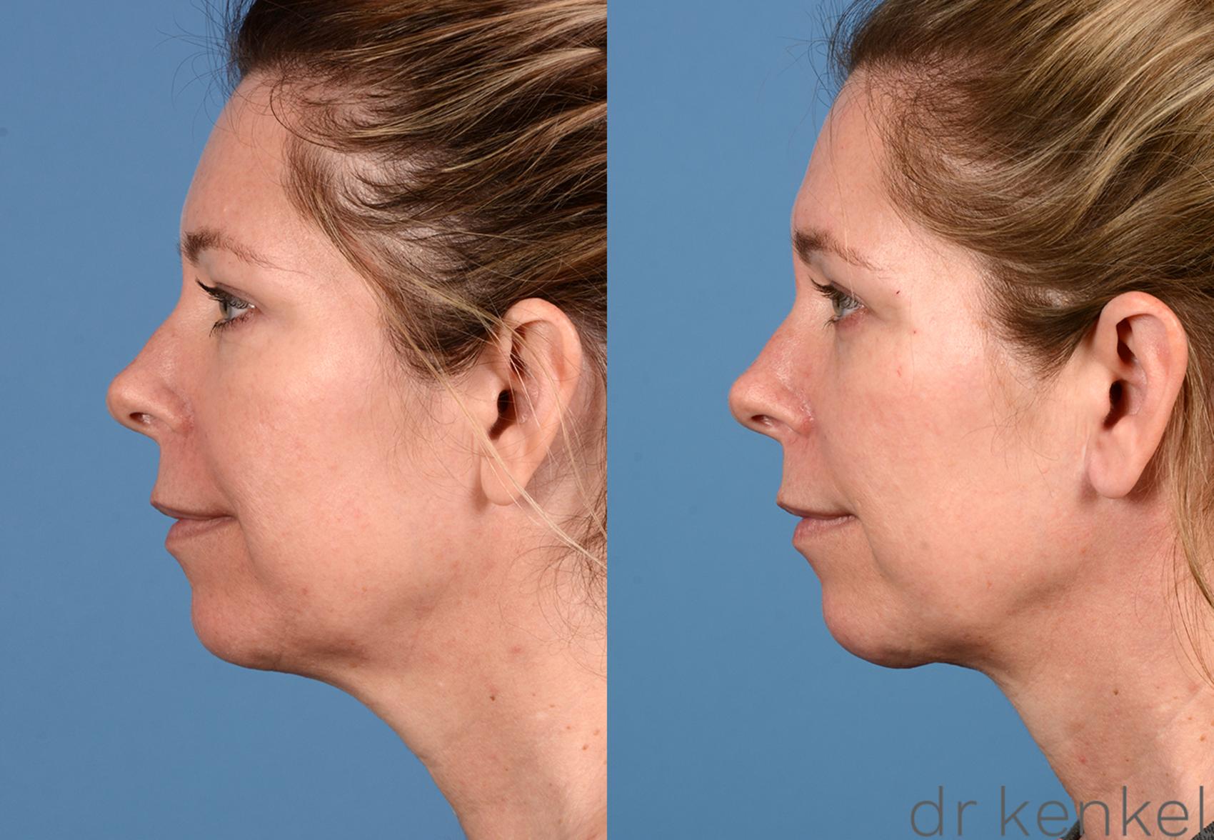 Before & After Neck Lift Case 281 View #3 View in Dallas, TX
