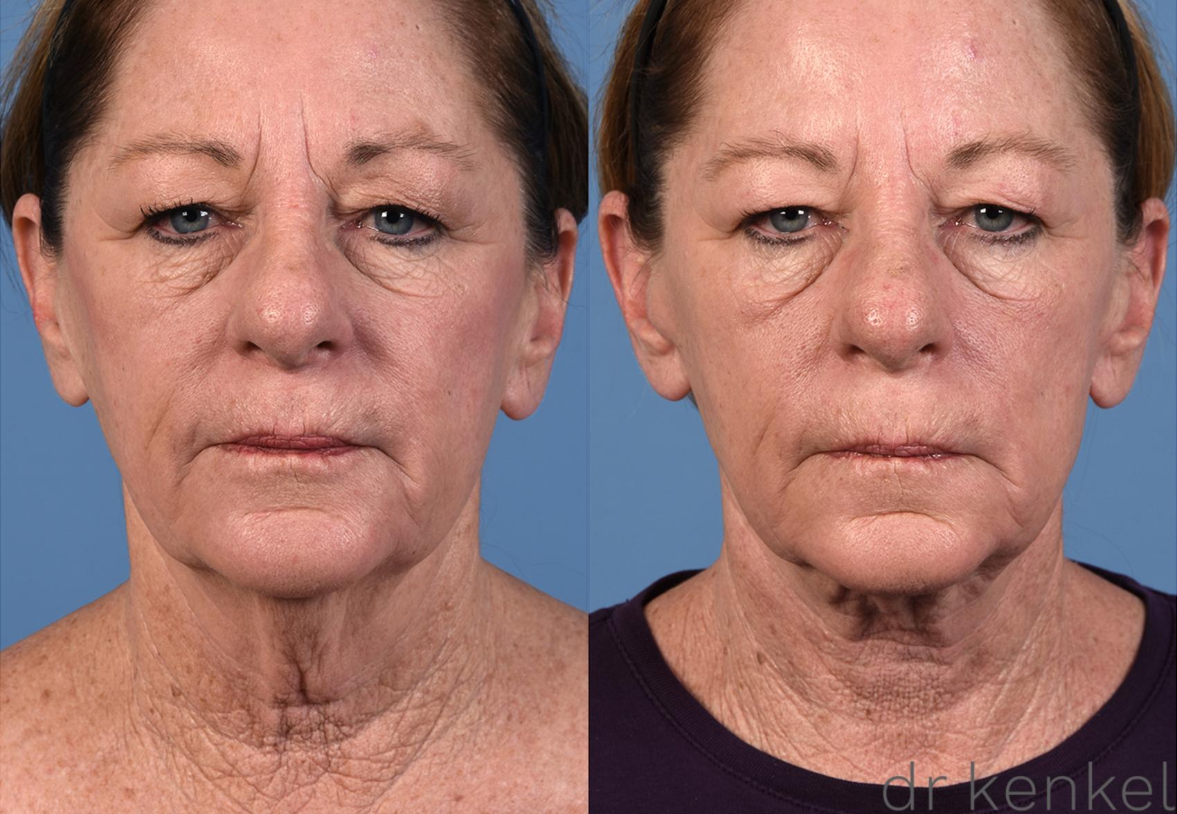 Before & After Neck Lift Case 308 View #1 View in Dallas, TX