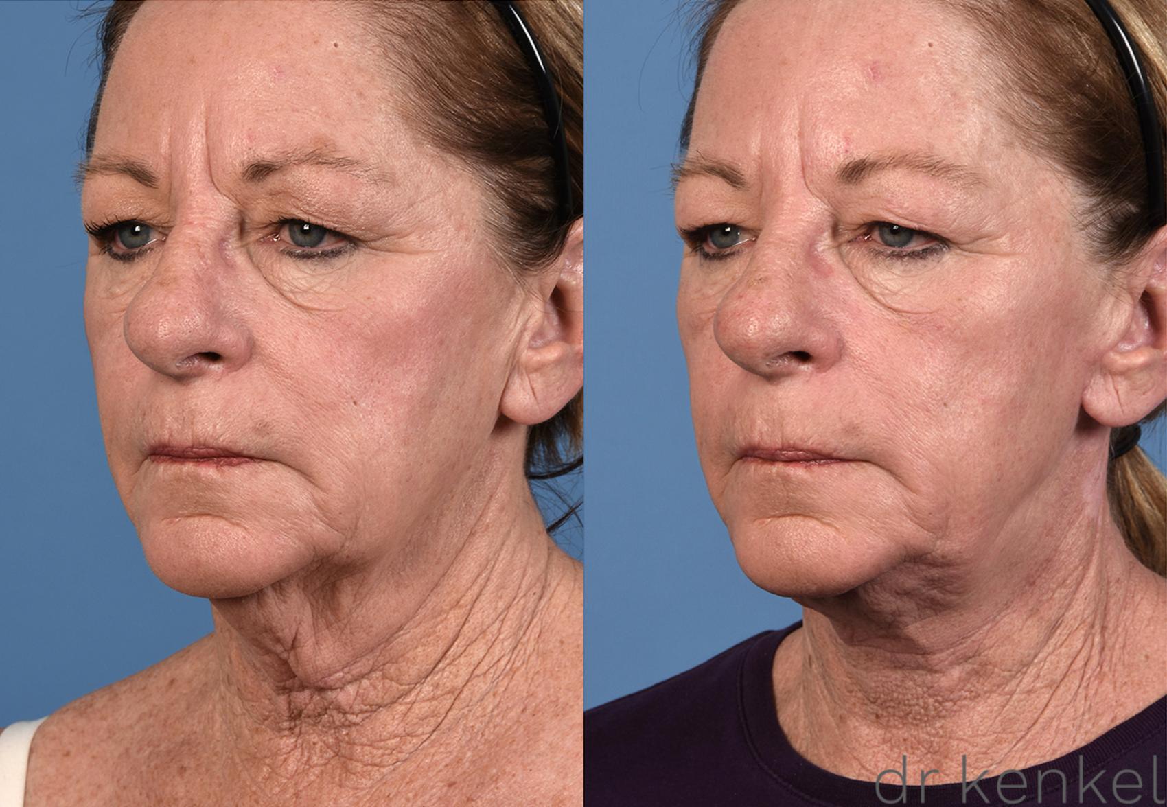 Before & After Neck Lift Case 308 View #2 View in Dallas, TX