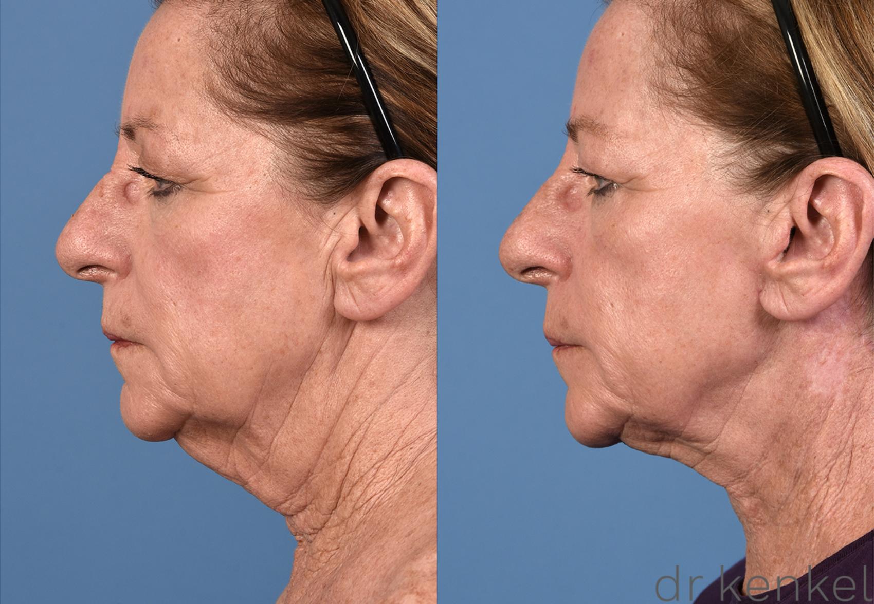 Before & After Neck Lift Case 308 View #3 View in Dallas, TX
