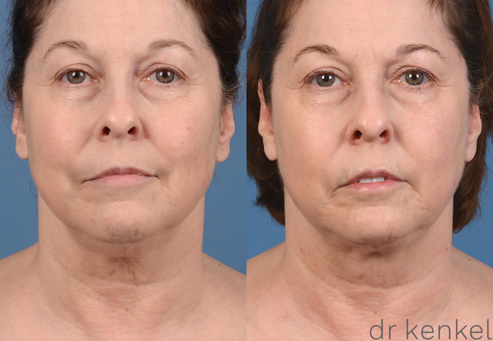 Before & After Neck Liposuction Case 319 View #1 View in Dallas, TX