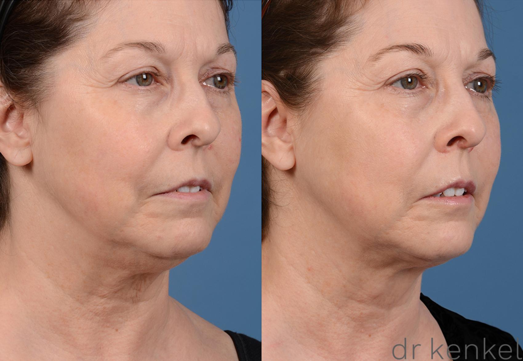 Before & After Neck Liposuction Case 319 View #2 View in Dallas, TX