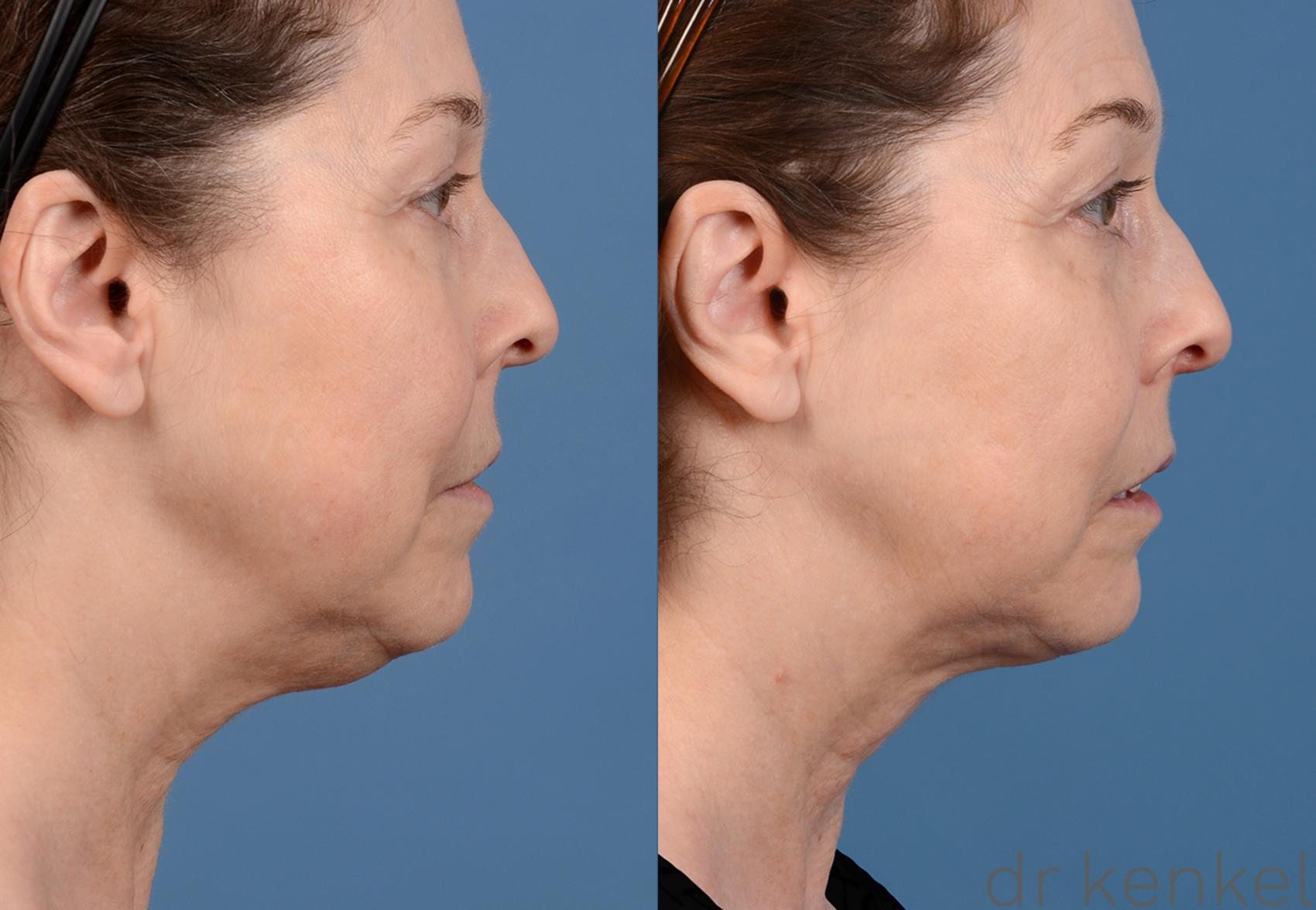 Before & After Neck Liposuction Case 319 View #3 View in Dallas, TX