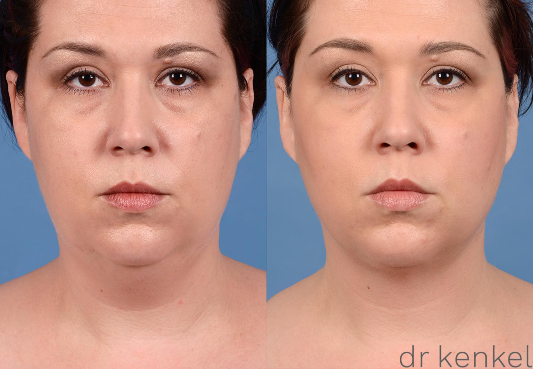Before & After Neck Liposuction Case 320 View #1 View in Dallas, TX