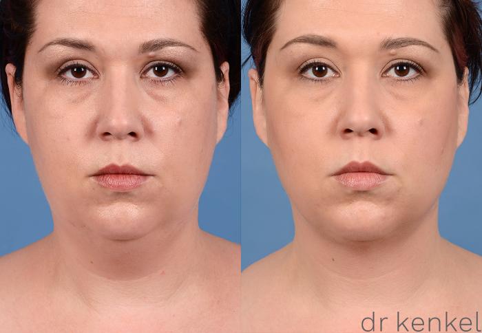 Before & After Neck Liposuction Case 320 View #1 View in Dallas, Frisco, Fort Worth, McKinney, Prosper, Allen, Celina, Denton, Anna, TX