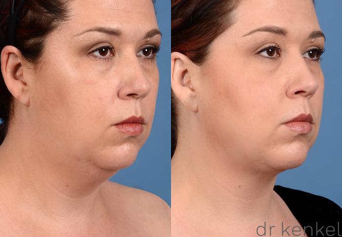Before & After Neck Liposuction Case 320 View #2 View in Dallas, Frisco, Fort Worth, McKinney, Prosper, Allen, Celina, Denton, Anna, TX