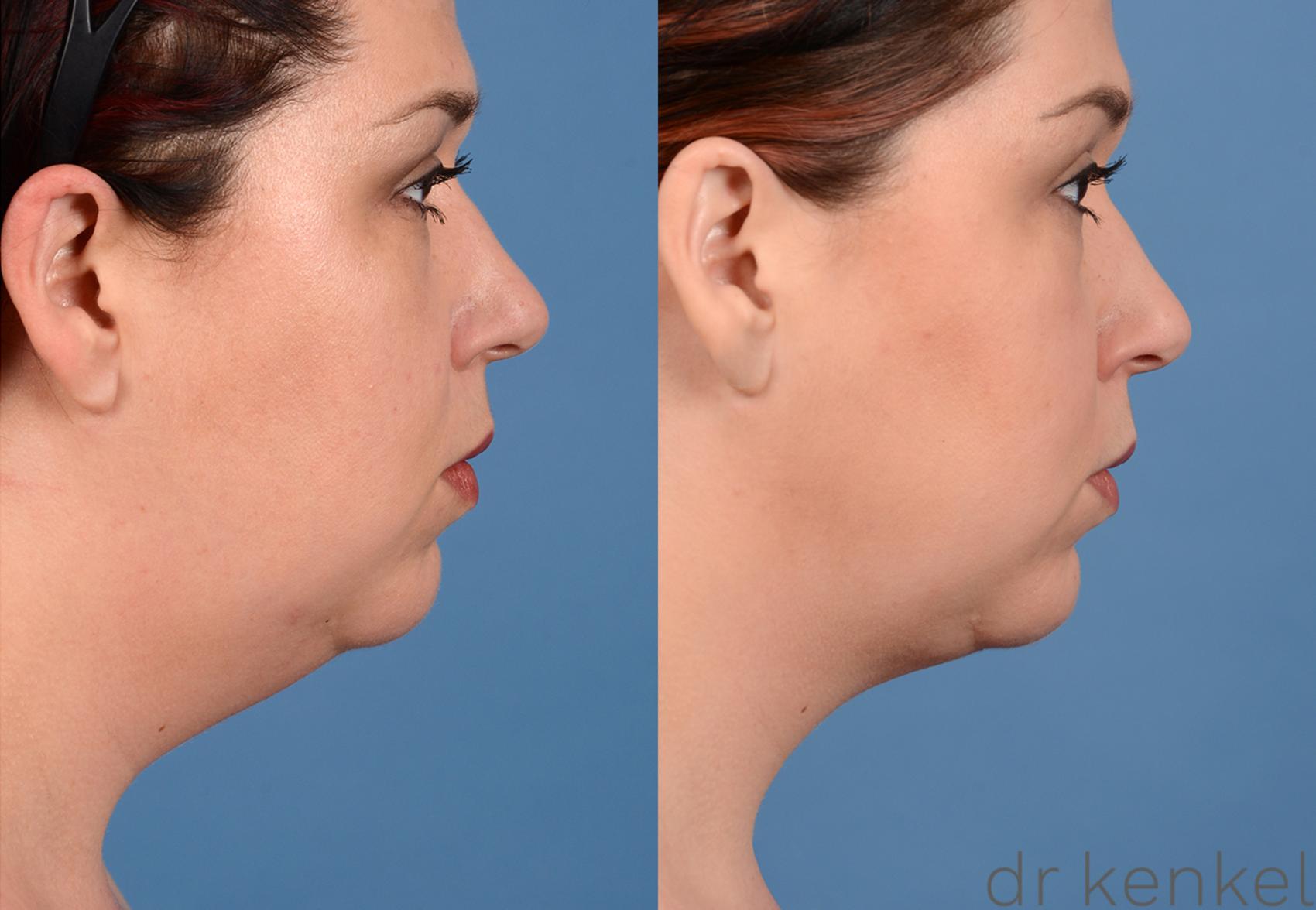 Before & After Neck Liposuction Case 320 View #3 View in Dallas, TX