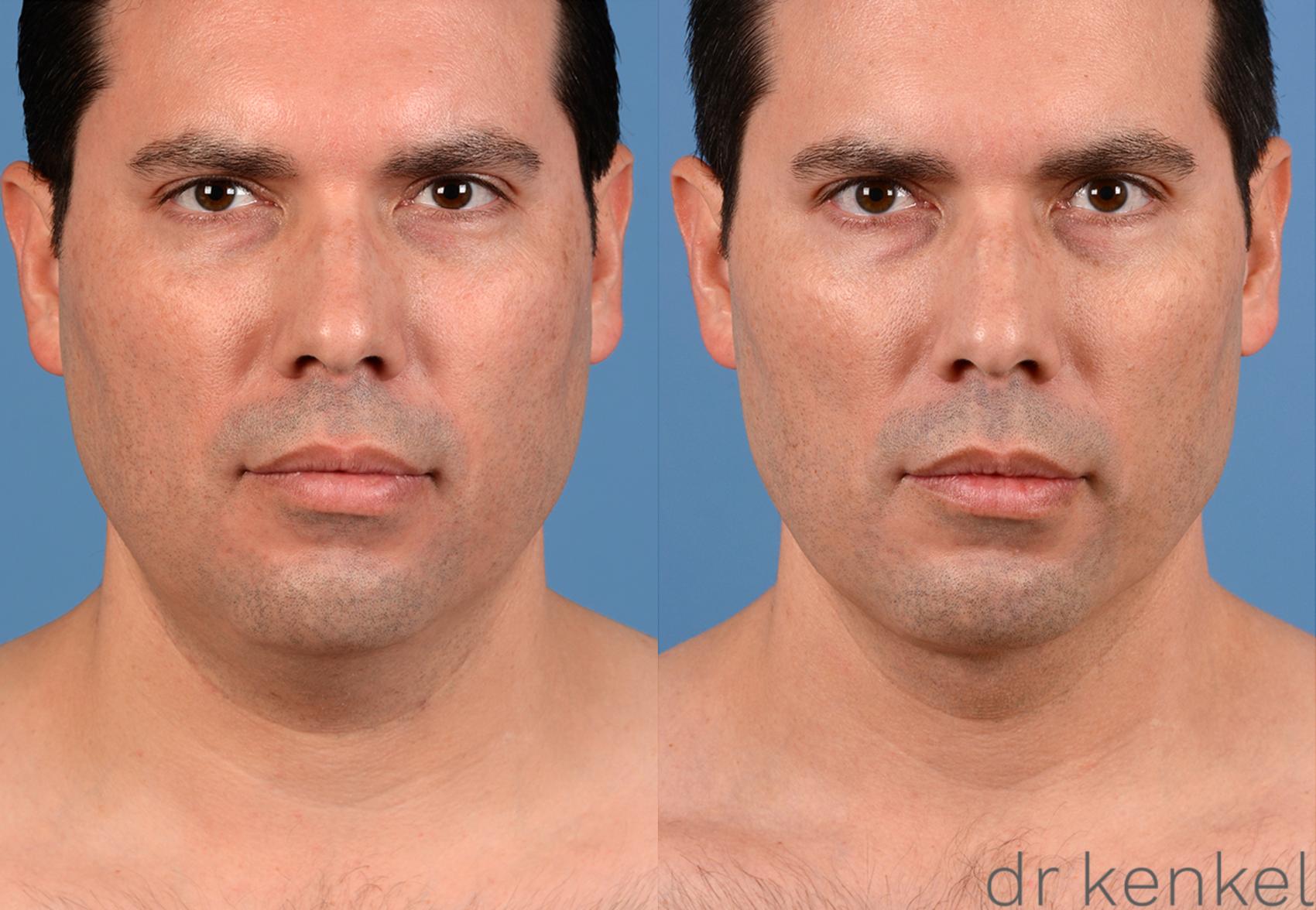 Before & After Neck Liposuction Case 321 View #1 View in Dallas, TX