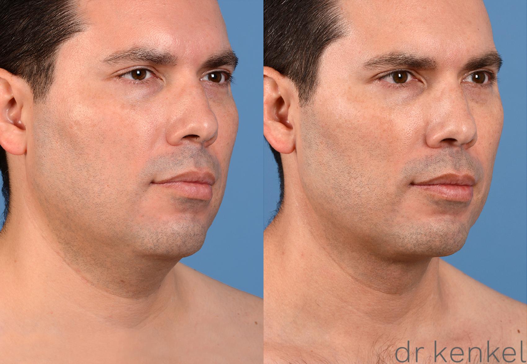 Before & After Neck Liposuction Case 321 View #2 View in Dallas, TX