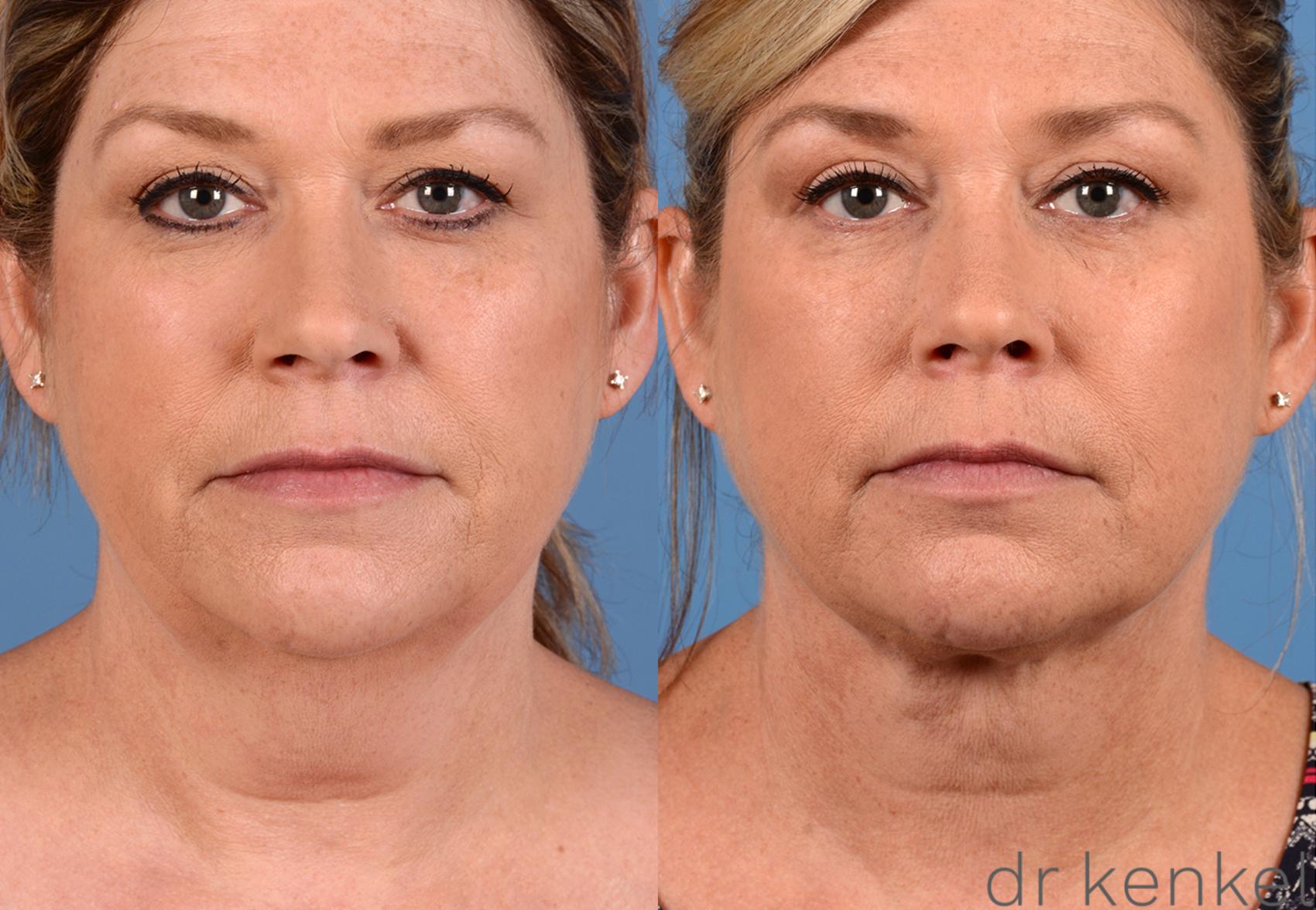 Before & After Neck Liposuction Case 322 View #1 View in Dallas, Frisco, Fort Worth, McKinney, Prosper, Allen, Celina, Denton, Anna, TX