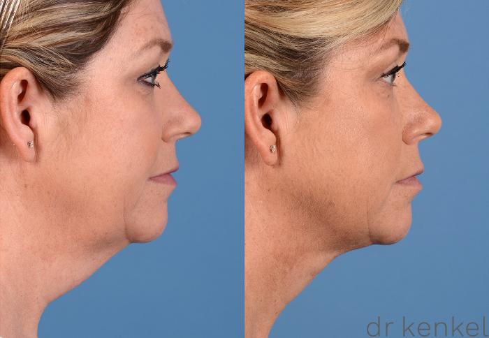 Before & After Neck Liposuction Case 322 View #3 View in Dallas, Frisco, Fort Worth, McKinney, Prosper, Allen, Celina, Denton, Anna, TX