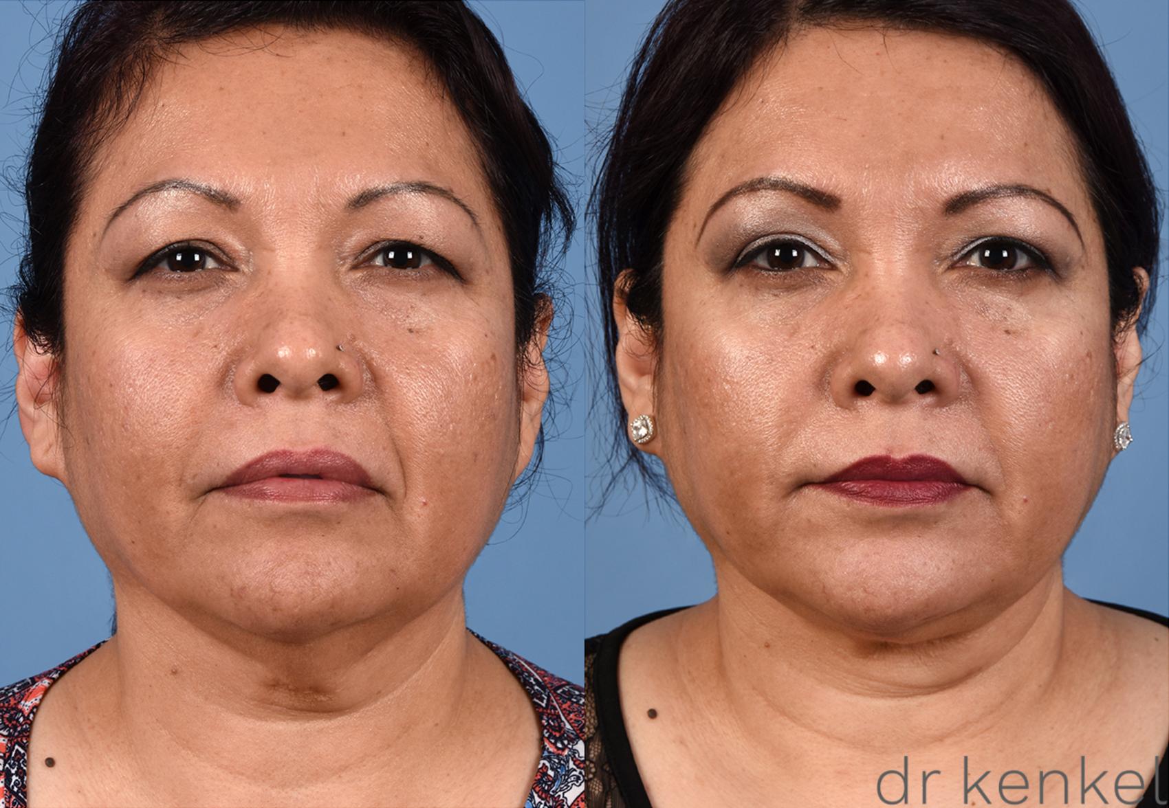 Before & After Neck Liposuction Case 324 View #1 View in Dallas, Frisco, McKinney, Prosper, Allen, Celina, Denton, Anna, TX