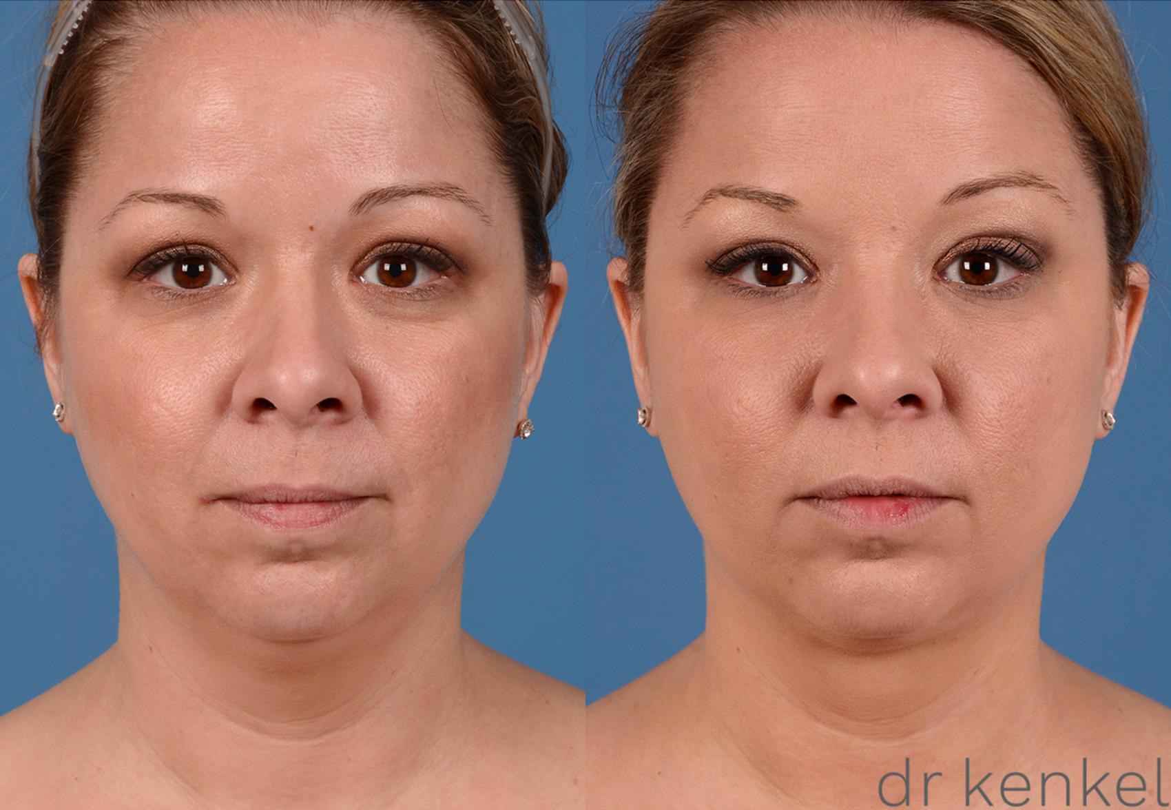 Before & After Neck Liposuction Case 325 View #1 View in Dallas, TX