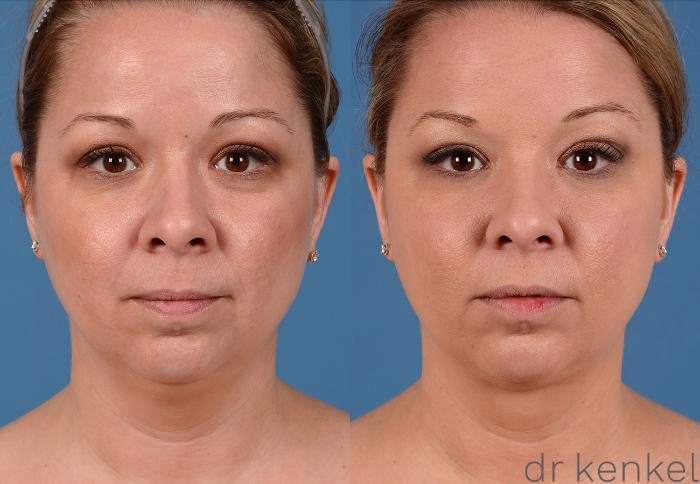 Before & After Neck Liposuction Case 325 View #1 View in Dallas, Frisco, Fort Worth, McKinney, Prosper, Allen, Celina, Denton, Anna, TX