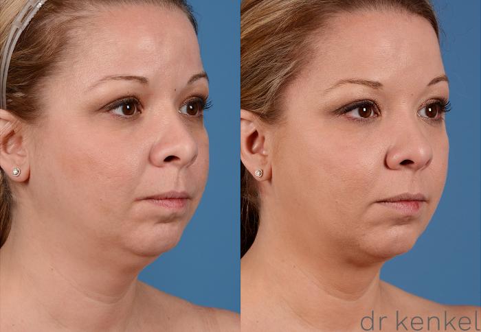 Before & After Neck Liposuction Case 325 View #2 View in Dallas, Frisco, McKinney, Prosper, Allen, Celina, Denton, Anna, TX