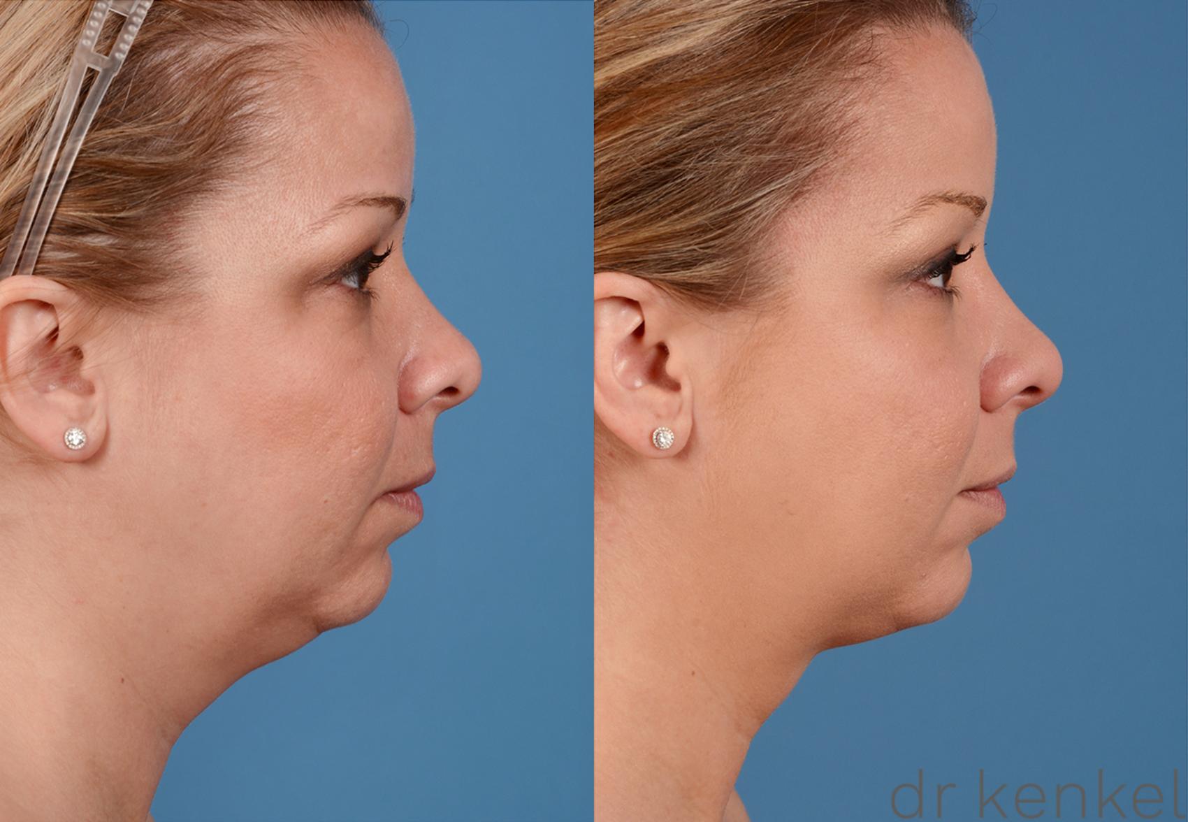 Neck Liposuction Case 325