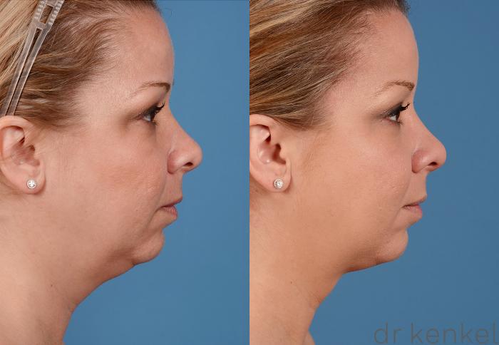 Before & After Neck Liposuction Case 325 View #3 View in Dallas, Frisco, McKinney, Prosper, Allen, Celina, Denton, Anna, TX