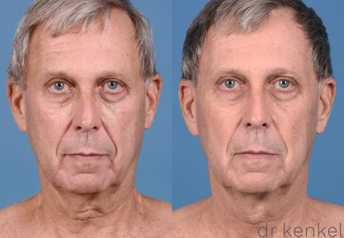 Before & After Nonsurgical for Men Case 173 View #1 View in Dallas, Frisco, McKinney, Prosper, Allen, Celina, Denton, Anna, TX