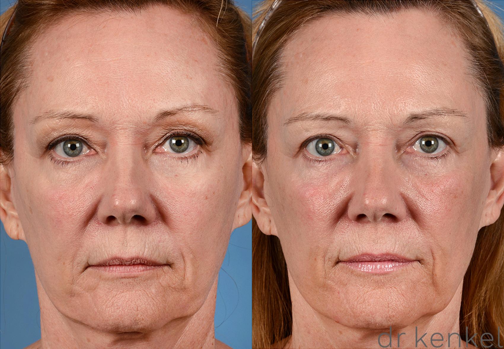 Before & After Laser Skin Resurfacing Case 207 View #1 View in Dallas, Frisco, McKinney, Prosper, Allen, Celina, Denton, Anna, TX