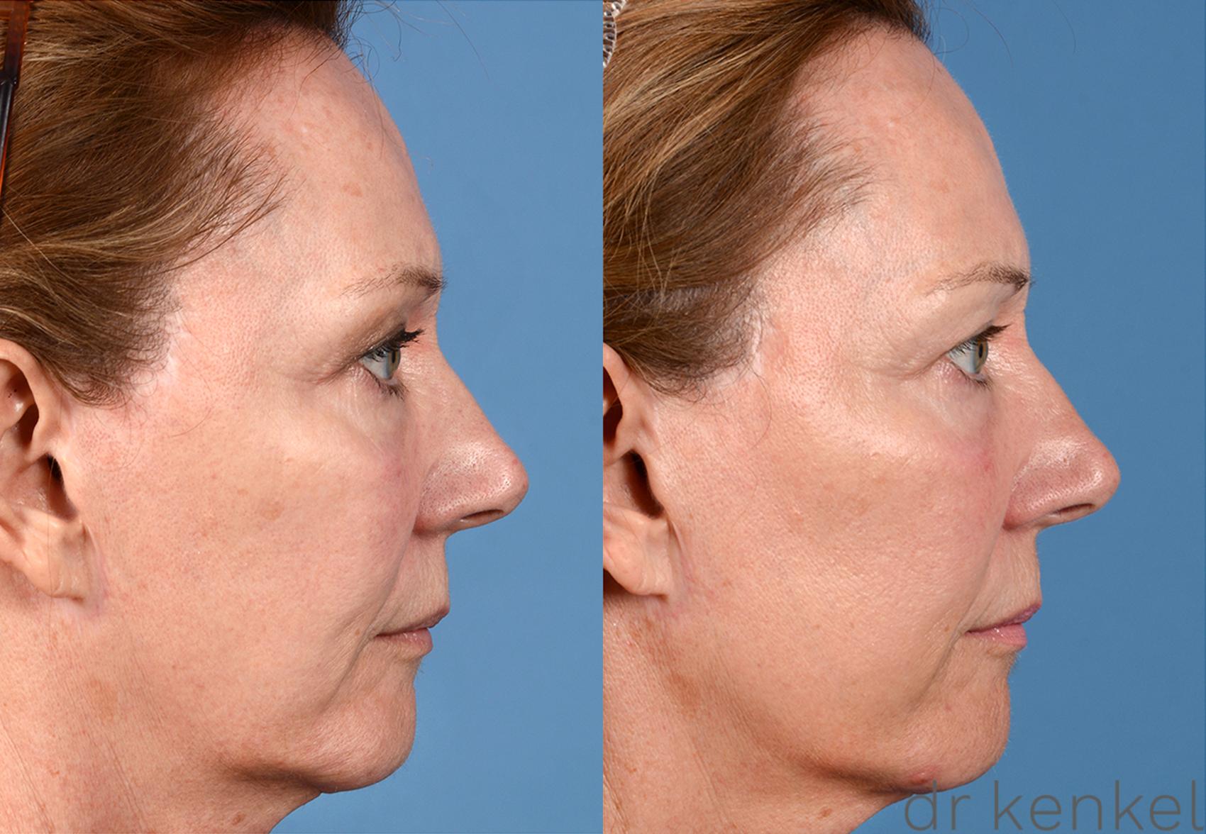 Before & After Photo Rejuvenation Case 207 View #2 View in Dallas, Frisco, McKinney, Prosper, Allen, Celina, Denton, Anna, TX