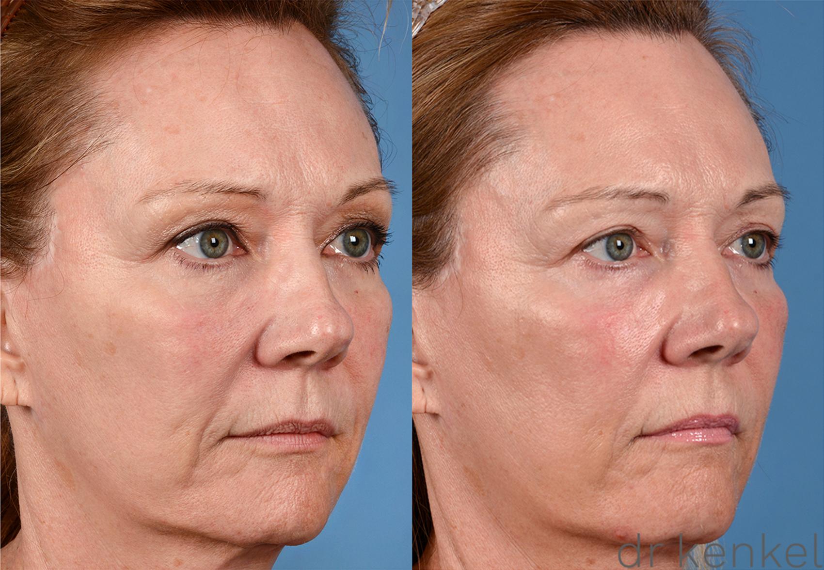 Before & After Photo Rejuvenation Case 207 View #3 View in Dallas, Frisco, McKinney, Prosper, Allen, Celina, Denton, Anna, TX