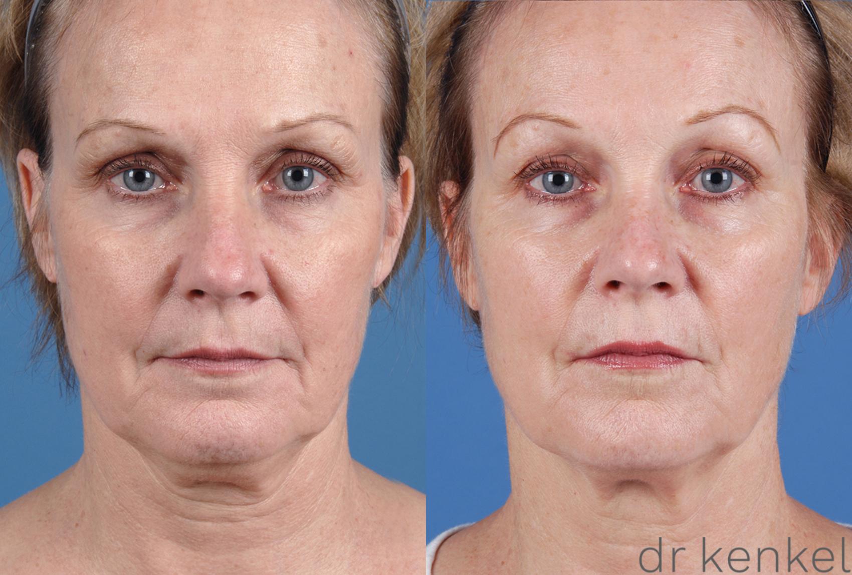 SKIN TIGHTENING BEFORE & AFTER PHOTOS